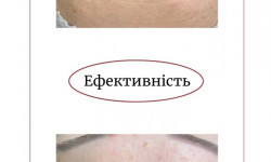 KEMI KUM пілінг Косметологический центр NEW LIFE Хмельницкий