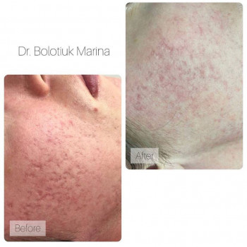 Лазерне CO2 шліфування обличчя
                    Косметологічний центр NEW LIFE Хмельницький