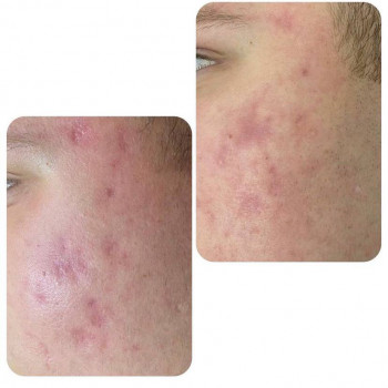 Лазерне CO2 шліфування обличчя
                    Косметологічний центр NEW LIFE Хмельницький