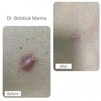 Лазерне CO2 шліфування обличчя
                    Косметологічний центр NEW LIFE Хмельницький