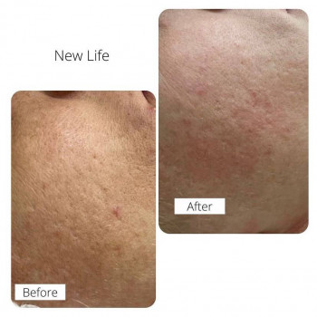 Лазерне CO2 шліфування обличчя
                    Косметологічний центр NEW LIFE Хмельницький