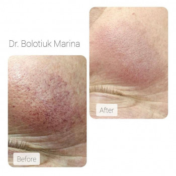 Лазерне лікування розацеа (щоки)
                    Косметологический центр NEW LIFE Хмельницкий