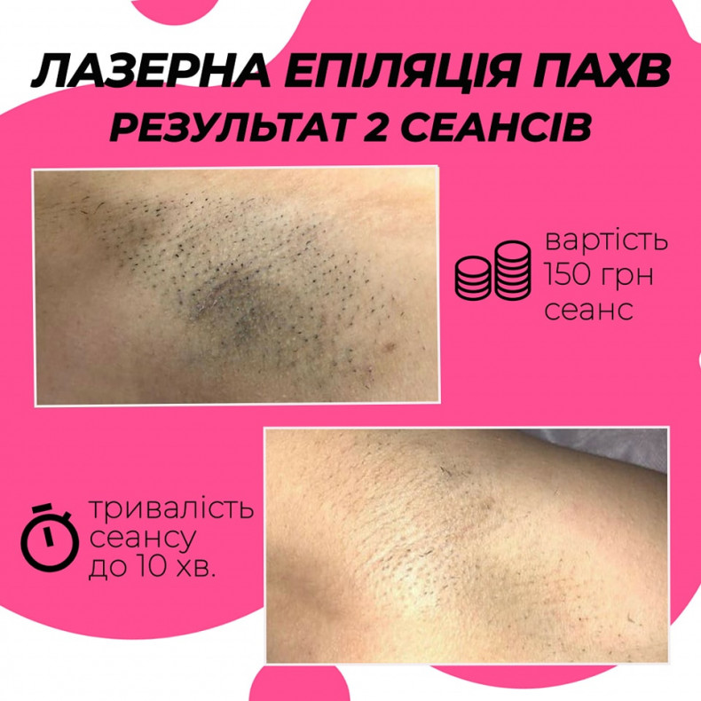 Лазерна епіляція пахв на діодному лазері - 400 грн/сеанс  #лазернаепіляція, фото - Салон краси Майстерня Краси "Юлії Юдіної"