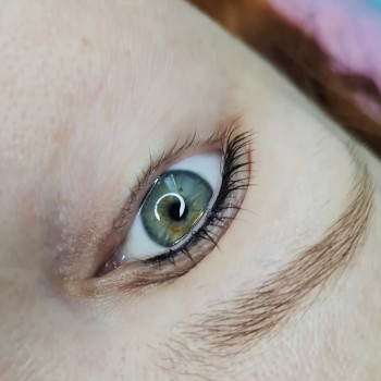 Заживша міжвійка після 1 процедури (без коррекції) та ламіну