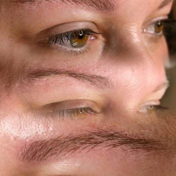 Волоскова реконструкція брів