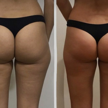 Корекція фігури, результати до та після курсу антицелюлітного масажу 
 # антицелюлітний масаж 
 # ко...