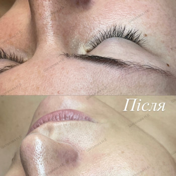 чистка обличчя