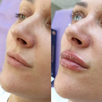 Збільшення объема губ
                    Перукар-візажист Елена Харків