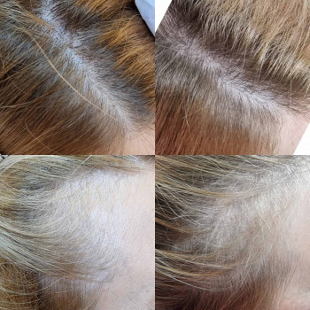 Мезотерапия головы
                    Косметолог-ін'єкціоніст Вероника Одеса