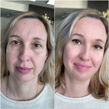 До/Після ПМ повік