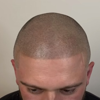 після 3 процедур