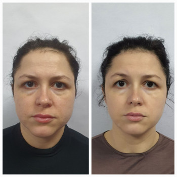 Масаж обличчя.