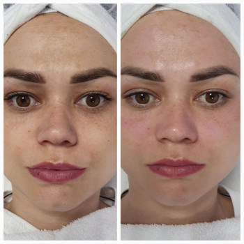 Комбінована чистка обличчя.