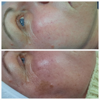 Феноловий пілінг.