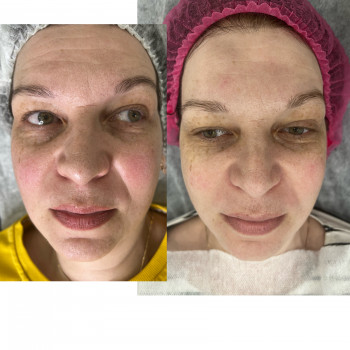 Курс 4 процеди PRX-T33