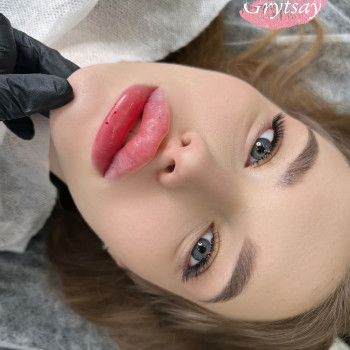 Збільшення губ
                    Косметолог-инъекционист Наталья Днепр