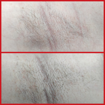 Электроэпиляция
                    Майстер депіляції Виктория Харків