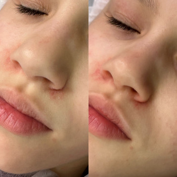 Плазмовий душ (омолодження)
                    Косметолог-эстетист Катерина Ивано-Франковск