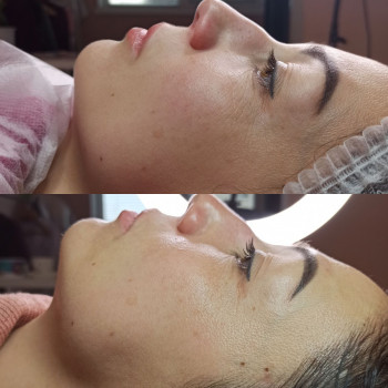 Плазмовий душ (омолодження)
                    Косметолог-эстетист Катерина Ивано-Франковск