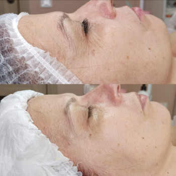 Плазмовий душ (омолодження)
                    Косметолог-эстетист Катерина Ивано-Франковск