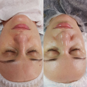 Плазмовий душ (омолодження)
                    Косметолог-эстетист Катерина Ивано-Франковск