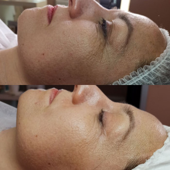 Плазмовий душ (омолодження)
                    Косметолог-эстетист Катерина Ивано-Франковск