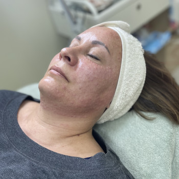 Биоревитализация
                    Косметолог Екатерина Київ