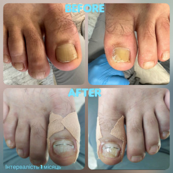   нігтів
  ногтей
 
  ніготь
  ноготь
 
 