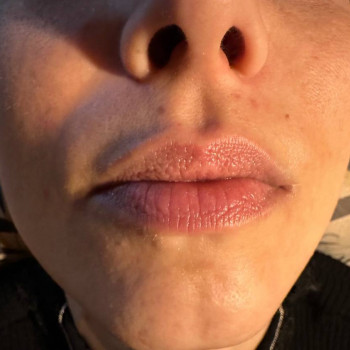 Аугментація губ "До"