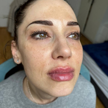 Зразу після процедури