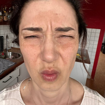 Ботулінотерапія "до"