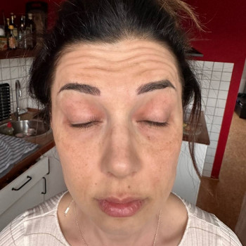 Ботулінотерапія "До"