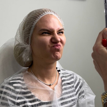 Ботулінотерапія "до"