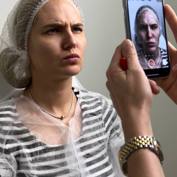 Ботулінотерапія "до"