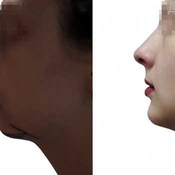 Геніопластика (пластика підборіддя)