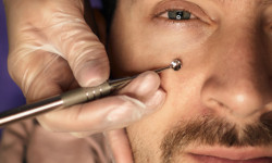 Механічна чистка обличчя Косметологический центр LASERGOOD Тернополь