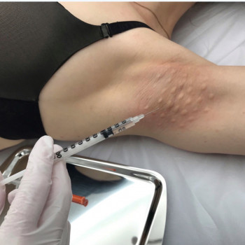 Процедура лікування гіпергідроза