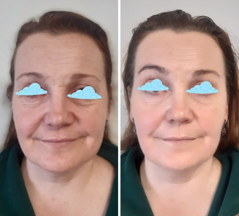 Скульптурний масаж 1 процедура, вік 54р., фото - Косметолог Светлана Богданович