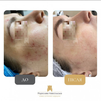 Результати Лікування акне