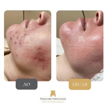 Результати Лікування акне
