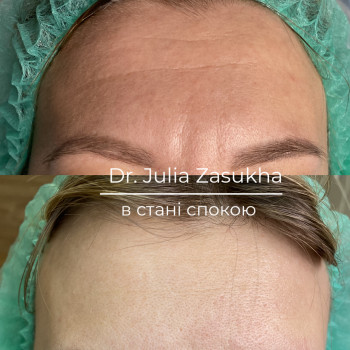 ботокс лба