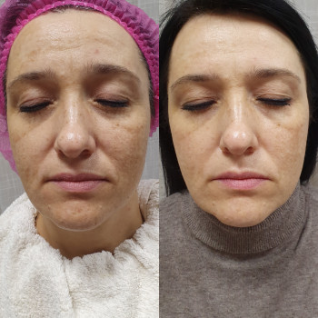 Терапія пігментації