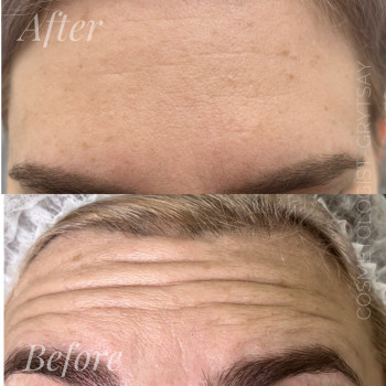 Ботулінотерапія
                    Косметолог-ін'єкціоніст Наталья Дніпро