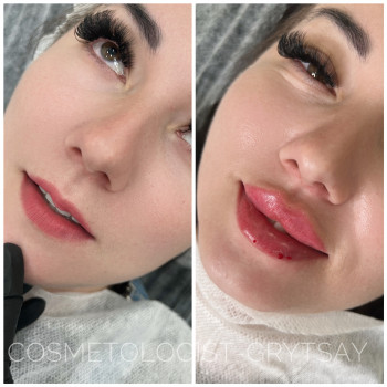 Збільшення губ
                    Косметолог-инъекционист Наталья Днепр