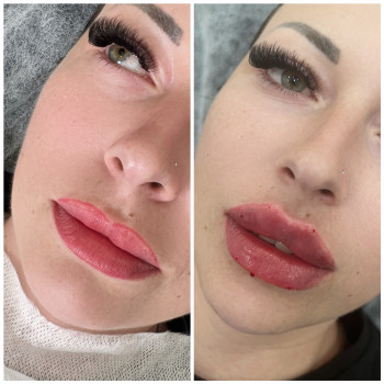 Збільшення губ
                    Косметолог-инъекционист Наталья Днепр
