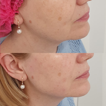 Контурна пластика