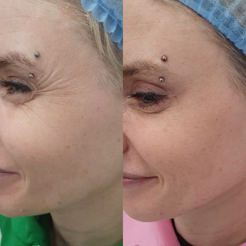 Корекція мімічних зморшок