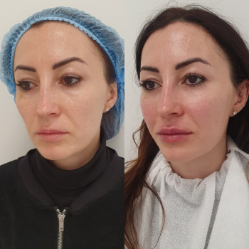 Контурна пластика - губи, скули