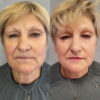 Контурна пластика - аугментація губ та підборіддя