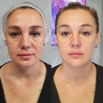 Контурна пластика 
STYLAGE L - 3 шприци